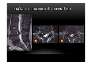 FENÔMENO DE REGRESSÃO ESPONTÂNEA
 