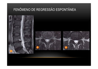 FENÔMENO DE REGRESSÃO ESPONTÂNEA
 