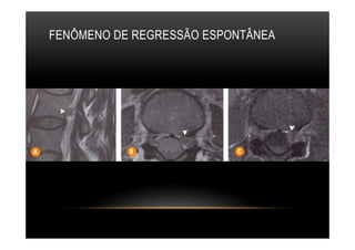 FENÔMENO DE REGRESSÃO ESPONTÂNEA
 