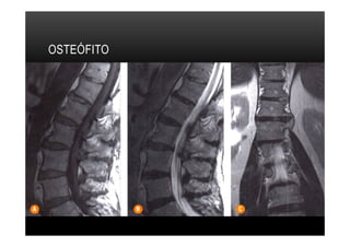 OSTEÓFITO
 