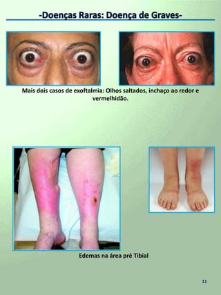  Hipertiroidismo ------------------------------------------- 10