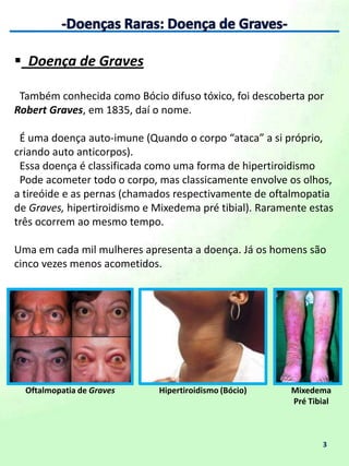  Doença de Graves -------------------------------------------------- 3