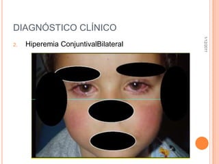 DIAGNÓSTICO CLÍNICO




                                      1/12/2011
2.   Hiperemia ConjuntivalBilateral
 