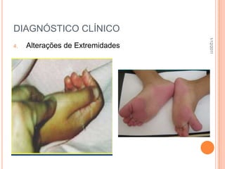 DIAGNÓSTICO CLÍNICO




                                  1/12/2011
4.   Alterações de Extremidades
 