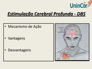 Estimulação Cerebral Profunda - DBS

• Mecanismo de Ação

• Vantagens

• Desvantagens
 