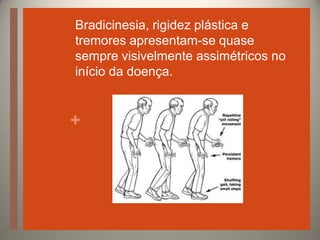 Bradicinesia, rigidez plástica e
tremores apresentam-se quase
sempre visivelmente assimétricos no
início da doença.

+

 