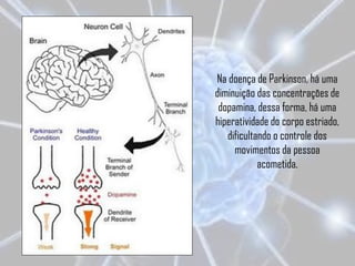 Na doença de Parkinson, há uma
diminuição das concentrações de
 dopamina, dessa forma, há uma
hiperatividade do corpo estriado,
   dificultando o controle dos
     movimentos da pessoa
            acometida.
 