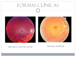 Formas clínicas
Mácula com Tay Sachs mácula normal
 