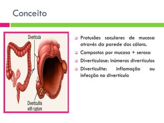 Conceito






Protusões saculares de mucosa
através da parede dos cólons.
Compostos por mucosa + serosa
Diverticulose: inúmeros divertículos
Diverticulite:
inflamação
ou
infecção no divertículo

 