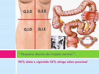 “ Pequeno desvio do trajeto normal ".
95% afeta o sigmóide 35% atinge cólon proximal

 