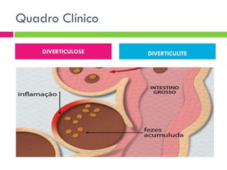 Quadro Clínico
DIVERTICULOSE






Assintomática/ Sintomática
- dor, distensão, alt. Hábito,
Sangramento pelo Reto,
- controle sintomático

DIVERTICULITE







Dor quadrante inferior E
(93-100%)
febre (57-100%)
massa abdominal, náuseas
constipação, diarréia, disúria

 