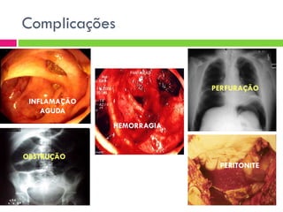 Complicações

PERFURAÇÃO
INFLAMAÇÃO
AGUDA
HEMORRAGIA

OBSTRUÇÃO
PERITONITE

 