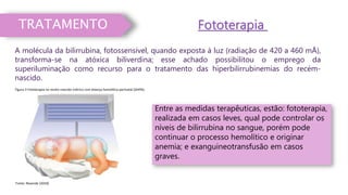 TRATAMENTO
A molécula da bilirrubina, fotossensível, quando exposta à luz (radiação de 420 a 460 mÅ),
transforma-se na atóxica biliverdina; esse achado possibilitou o emprego da
superiluminação como recurso para o tratamento das hiperbilirrubinemias do recém-
nascido.
Entre as medidas terapêuticas, estão: fototerapia,
realizada em casos leves, qual pode controlar os
níveis de bilirrubina no sangue, porém pode
continuar o processo hemolítico e originar
anemia; e exanguineotransfusão em casos
graves.
Fototerapia
Figura 3 Fototerapia no recém-nascido ictérico com doença hemolítica perinatal (DHPN).
Fonte: Resende (2018)
 