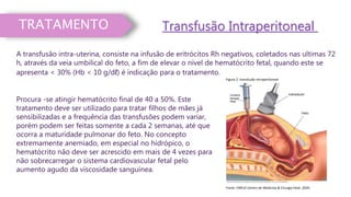 A transfusão intra-uterina, consiste na infusão de eritrócitos Rh negativos, coletados nas ultimas 72
h, através da veia umbilical do feto, a fim de elevar o nível de hematócrito fetal, quando este se
apresenta < 30% (Hb < 10 g/dℓ) é indicação para o tratamento.
TRATAMENTO Transfusão Intraperitoneal
Procura -se atingir hematócrito final de 40 a 50%. Este
tratamento deve ser utilizado para tratar filhos de mães já
sensibilizadas e a frequência das transfusões podem variar,
porém podem ser feitas somente a cada 2 semanas, até que
ocorra a maturidade pulmonar do feto. No concepto
extremamente anemiado, em especial no hidrópico, o
hematócrito não deve ser acrescido em mais de 4 vezes para
não sobrecarregar o sistema cardiovascular fetal pelo
aumento agudo da viscosidade sanguínea.
Figura 2. transfusão intraperitoneal
Fonte: FMFLA Centro de Medicina & Cirurgia Fetal ,2020
 
