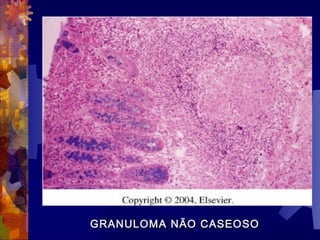 GRANULOMA NÃO CASEOSOGRANULOMA NÃO CASEOSO
 