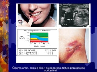 Úlceras orais, cálculo biliar, osteoporose, fístula para parede
abdominal
 
