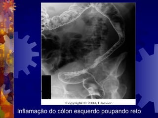 Inflamação do cólon esquerdo poupando reto
 