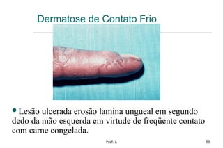 Prof. L 89
Dermatose de Contato Frio
Lesão ulcerada erosão lamina ungueal em segundo
dedo da mão esquerda em virtude de freqüente contato
com carne congelada.
 