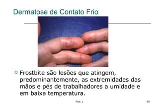 Prof. L 90
Dermatose de Contato Frio
 Frostbite são lesões que atingem,
predominantemente, as extremidades das
mãos e pés de trabalhadores a umidade e
em baixa temperatura.
 