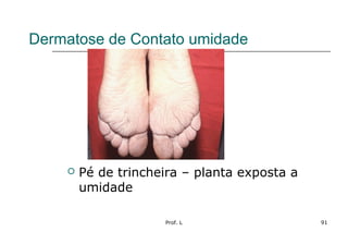Prof. L 91
Dermatose de Contato umidade
 Pé de trincheira – planta exposta a
umidade
 