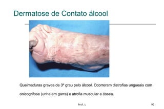 Prof. L 92
Dermatose de Contato álcool
Queimaduras graves de 3º grau pelo álcool. Ocorreram distrofias ungueais com
onicogrifose (unha em garra) e atrofia muscular e óssea.
 