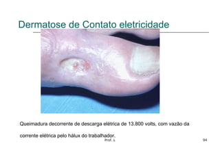 Prof. L 94
Dermatose de Contato eletricidade
Queimadura decorrente de descarga elétrica de 13.800 volts, com vazão da
corrente elétrica pelo hálux do trabalhador.
 