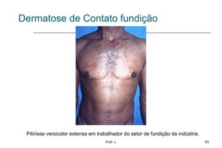 Prof. L 95
Dermatose de Contato fundição
Pitiríase versicolor extensa em trabalhador do setor de fundição da indústria.
 