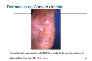 Prof. L 96
Dermatose de Contato cimento
Dermatite irritativa de contato forte (DICF) em ajudante de pedreiro, portador de
ictiose vulgar. Veja fotos 12, 13 e 14.
 