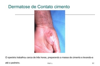Prof. L 97
Dermatose de Contato cimento
O operário trabalhou cerca de três horas, preparando a massa de cimento e levando-a
até o pedreiro.
 