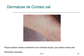 Prof. L 98
Dermatose de Contato sal
Papoca plantar: lesões inicialmente com conteúdo líquido, que podem evoluir para
ferimentos ulcerados.
 