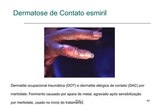Prof. L 99
Dermatose de Contato esmiril
Dermatite ocupacional traumática (DOT) e dermatite alérgica de contato (DAC) por
mertiolate. Ferimento causado por apara de metal, agravado após sensibilização
por mertiolate, usado no início do tratamento.
 
