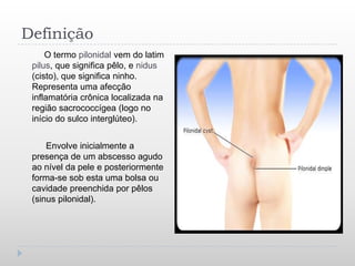 Definição
     O termo pilonidal vem do latim
 pilus, que significa pêlo, e nidus
 (cisto), que significa ninho.
 Representa uma afecção
 inflamatória crônica localizada na
 região sacrococcígea (logo no
 início do sulco interglúteo).


     Envolve inicialmente a
 presença de um abscesso agudo
 ao nível da pele e posteriormente
 forma-se sob esta uma bolsa ou
 cavidade preenchida por pêlos
 (sinus pilonidal).
 