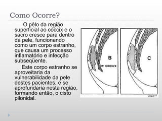 Como Ocorre?
      O pêlo da região
 superficial ao cóccix e o
 sacro cresce para dentro
 da pele, funcionando
 como um corpo estranho,
 que causa um processo
 inflamatório e infecção
 subseqüente.
     Este corpo estranho se
 aproveitaria da
 vulnerabilidade da pele
 destes pacientes, e se
 aprofundaria nesta região,
 formando então, o cisto
 pilonidal.
 