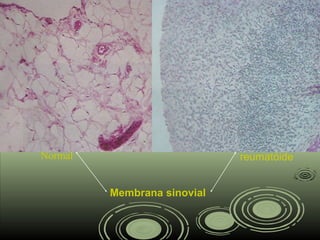 Membrana sinovial
Normal reumatóide
 