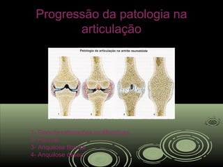 Progressão da patologia naProgressão da patologia na
articulaçãoarticulação
1- Sinovite+alterações proliferativas
2- Pannus
3- Anquilose fibrosa
4- Anquilose óssea
 