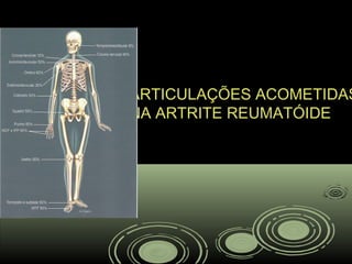 ARTICULAÇÕES ACOMETIDAS
NA ARTRITE REUMATÓIDE
 