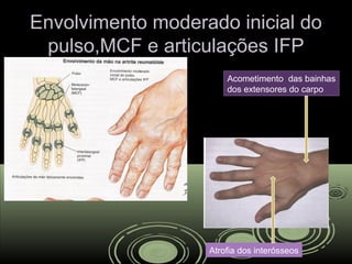 Envolvimento moderado inicial doEnvolvimento moderado inicial do
pulso,MCF e articulações IFPpulso,MCF e articulações IFP
Acometimento das bainhas
dos extensores do carpo
Atrofia dos interósseos
 