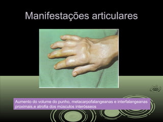 Manifestações articularesManifestações articulares
Aumento do volume do punho, metacarpofalangeanas e interfalangeanas
proximais,e atrofia dos músculos interósseos
 