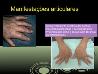 Manifestações articularesManifestações articulares
Comprometimento simétrico dos punhos,
metacarpofalangeanas e interfalangeanas
Proximais,bem como o desvio ulnar das meta-
carpofalangeanas
 