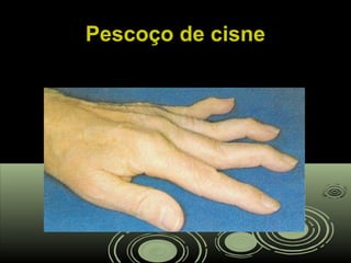 Pescoço de cisnePescoço de cisne
 