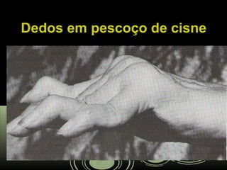 Dedos em pescoço de cisneDedos em pescoço de cisne
 