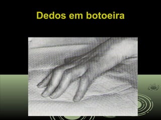 Dedos em botoeiraDedos em botoeira
 