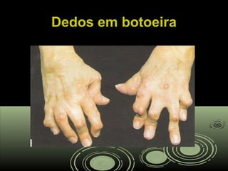 Dedos em botoeiraDedos em botoeira
 