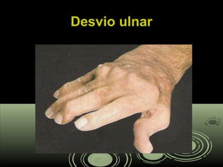 Desvio ulnarDesvio ulnar
 