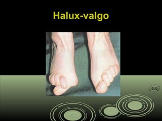 Halux-valgoHalux-valgo
 