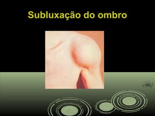 Subluxação do ombroSubluxação do ombro
 