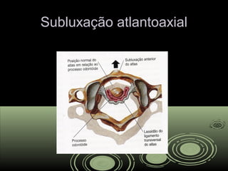 Subluxação atlantoaxialSubluxação atlantoaxial
 