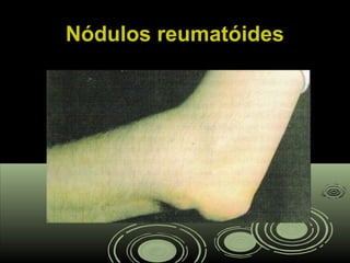 Nódulos reumatóidesNódulos reumatóides
 