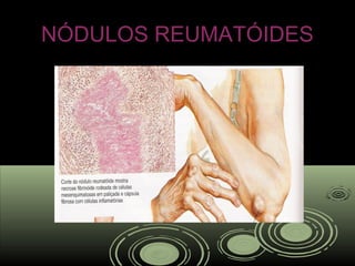 NÓDULOS REUMATÓIDESNÓDULOS REUMATÓIDES
 