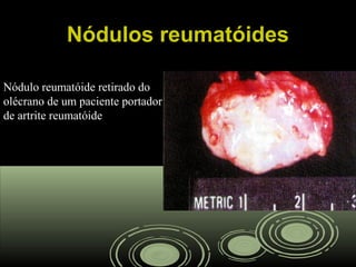 Nódulos reumatóidesNódulos reumatóides
Nódulo reumatóide retirado do
olécrano de um paciente portador
de artrite reumatóide
 